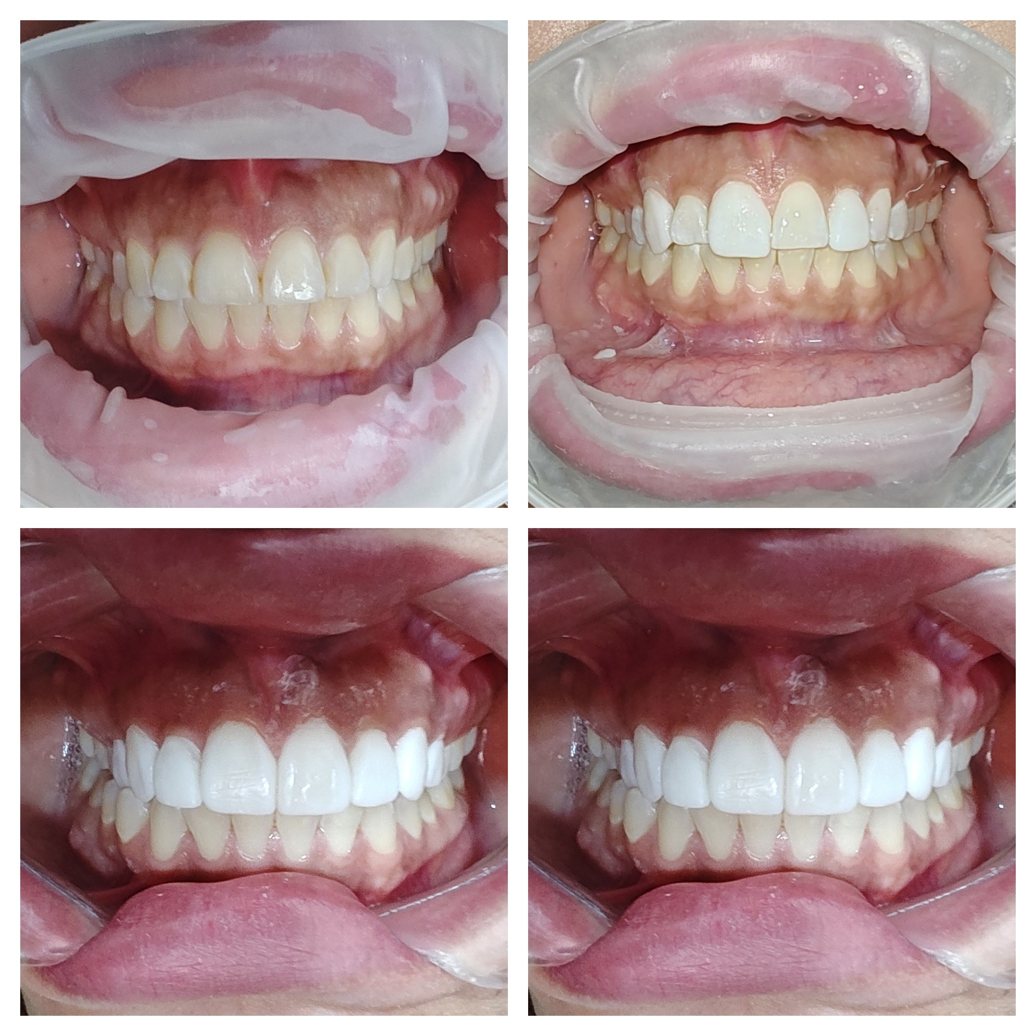 Transformación de sonrisa completa